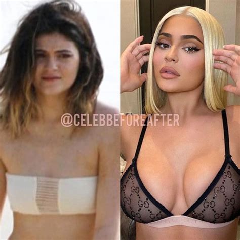 these before and after pics of kylie jenner are insane did she have