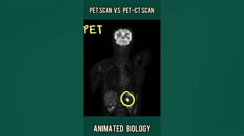Pet Scan Vs Pet Ct Scan In 1 Minute How Pet Scan Can Detect Cancer
