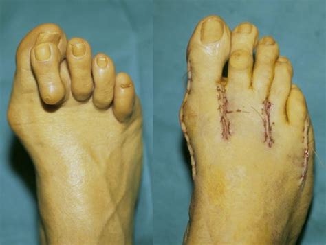 Hammer Toes Before And After Surgery Medizzy