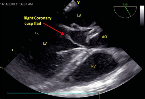 Transesophageal Echocardiography Showing Right Coronary Cusp Flail