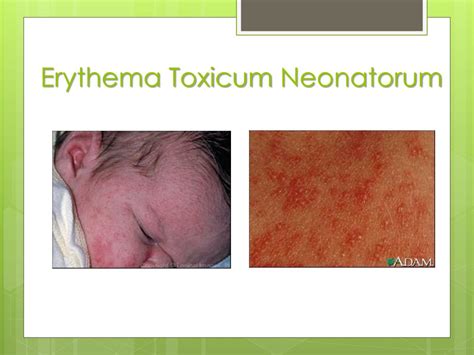 Acne Neonatorum Vs Erythema Toxicum
