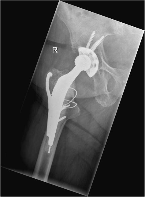 Outcomes Of Osteosynthesis Of Periprosthetic Fractures Of The Greater