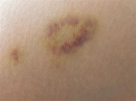 Can Skin Cancer Look Like A Bruise Cancerwalls