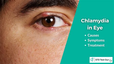 Causes Of Chlamydia In Eye Symptoms Treatment And Testing