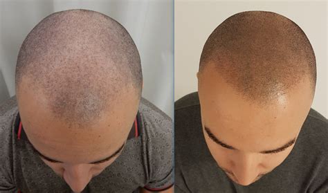 Doch vor allem eines macht alles nur noch schlimmer, als dass es hilft. Haartransplantation Forum : Alternativen / Ergänzungen (z ...