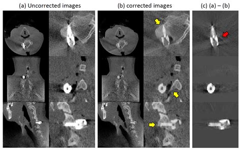 Applied Sciences Free Full Text Metal Artifact Reduction In X Ray