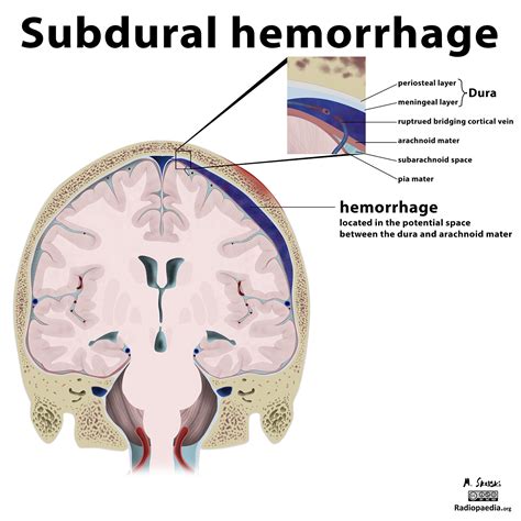 This characteristic can be a distinguishing feature between epidural and subdural hematomas. SUBDURAL VS EPIDURAL HEMATOMA RADIOLOGY - Wroc?awski ...