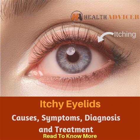 Itchy Eyelids Causes Picture Symptoms And Treatment