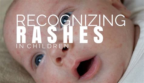 Infant Toddler And Children Rashes Rashes In Children