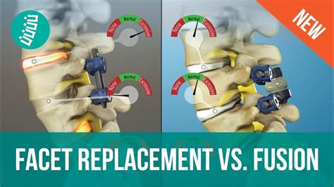 Facet Joint Replacement Vs Spine Fusion Youtube