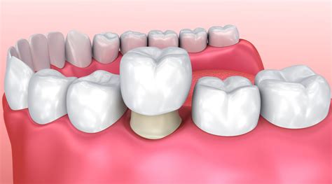 Coronas Y Puentes Dentales De Porcelana ¿cuándo Son Necesarios