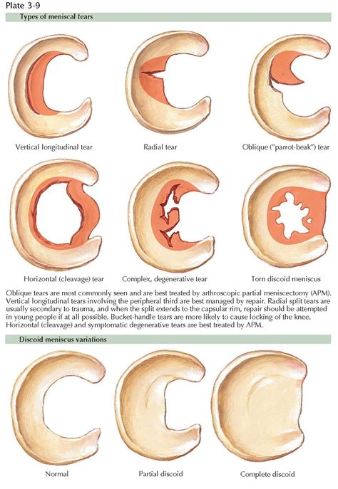 Meniscal Variations And Tears Pediagenosis