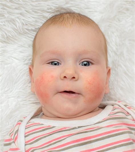 Signs Of Baby Allergic Reaction Allergy Trigger