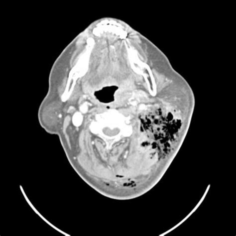 A 2b Contrast Enhanced Ct Scan Of The Neck Clearly Demonstrates