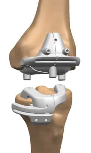 Knee Implants Customized Personalized And Specialized Options