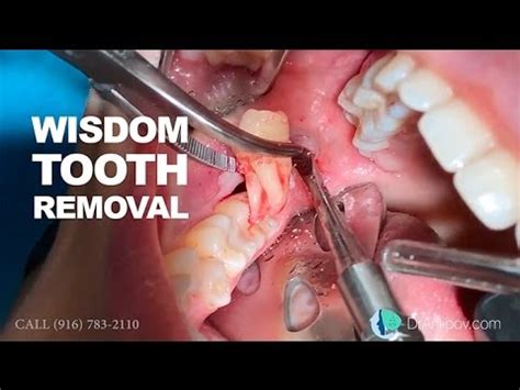Wisdom Teeth Removal What To Expect After TeethWalls