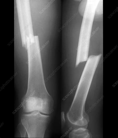 Fractured Femoral Shaft X Rays Stock Image C0403064 Science