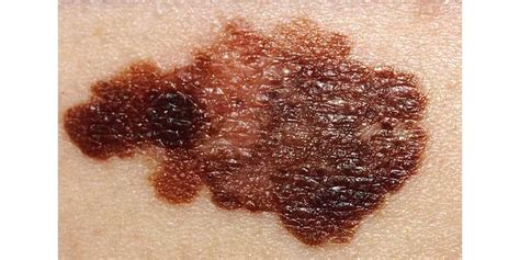 What Are Moles How To Recognize A Cancerous Mole