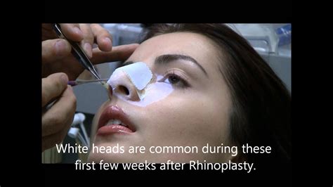 Nasal Cast Removal After Rhinoplasty Youtube