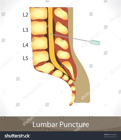 Lumbar Puncture Detailed Diagram Of Lumbar Puncture Spine Anatomy