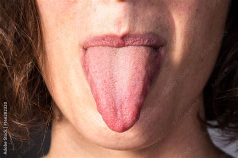 Very Long Tongue Out Of Mouth To Verify Candica Infection Stock Photo Adobe Stock