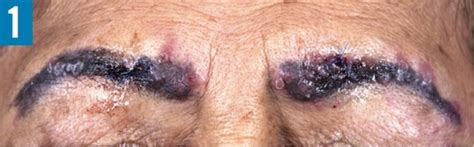 69 Year Old Female With Pruritic Rash On Eyebrows And Lymphadenopathy