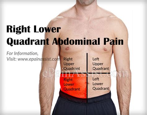 What Can Cause Right Lower Quadrant Abdominal Pain And How Is It Treated