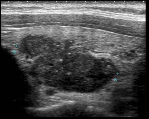 Medullary Thyroid Cancer Ultrasound