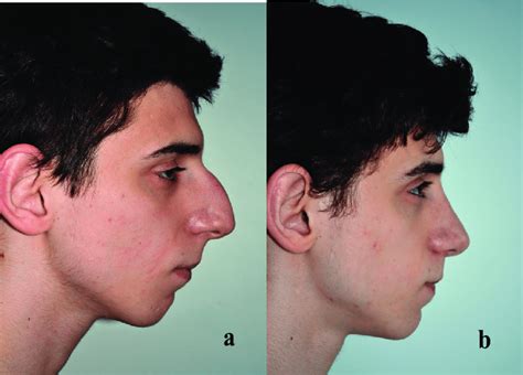 Illusional Change In The Perception Of The Position Of The Chin In