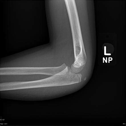 Olecranon and radial neck fractures | Image | Radiopaedia.org