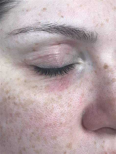 Skin Concerns Any Idea What Is Going On With My Eyes More Info And