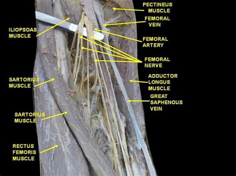 Lesions Of The Femoral Nerve