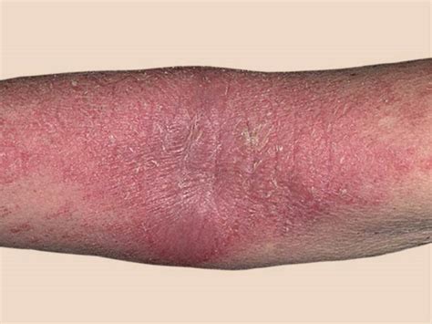 Dermatitis On Arms Pictures Symptoms And Pictures