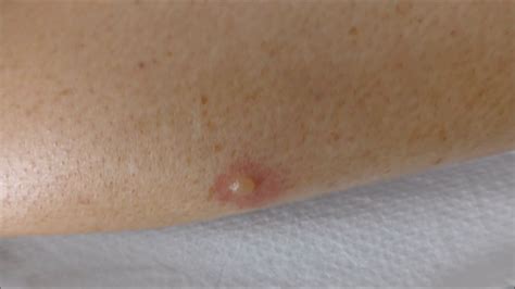Spider Bites Little Blisters However Some People Are Allergic To The