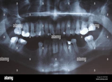 X Ray Scan Of Humans Teeth Stock Photo Alamy