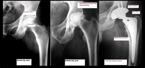 Hip Replacement Operation