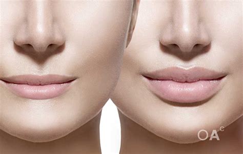 Dermal Fillers Oconnell Aesthetics Clinic