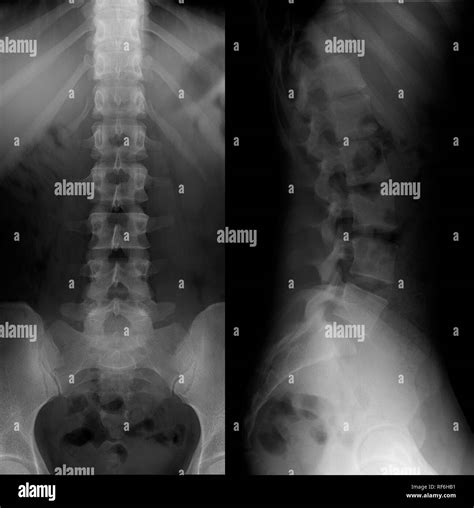 X Ray Normal Lumbar Spine High Resolution Stock Photography And Images
