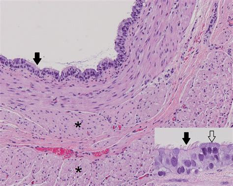 Foregut Duplication Cyst Associated With Esophageal Atresia And