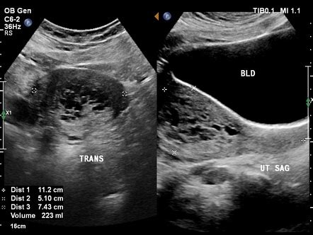 Complete Hydatidiform Molar Pregnancy Radiology Case Radiopaedia Org
