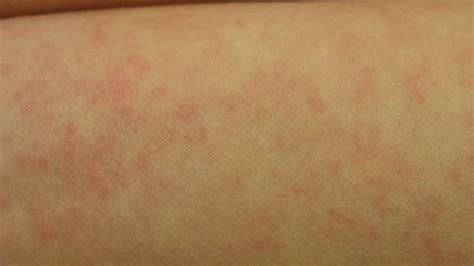 Early Stage Anxiety Stress Hives