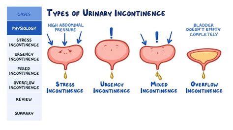 Urine Incontinence Types