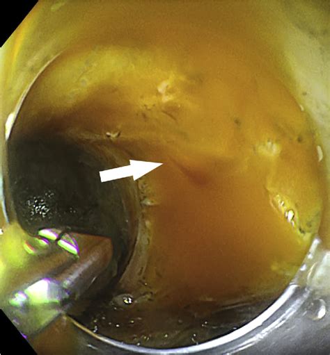 Figure 2 From Red Dichromatic Imaging In Peroral Endoscopic Myotomy A