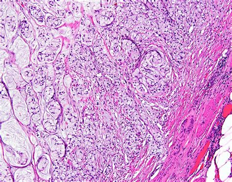 Pathology Outlines Goblet Cell Adenocarcinoma