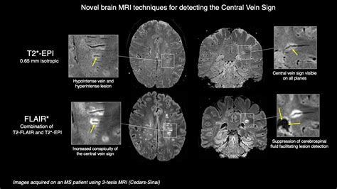 A Clearer Picture Of Multiple Sclerosis