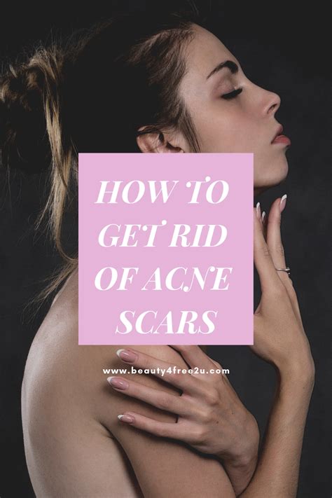 how to get rid of acne scars acnepositivity