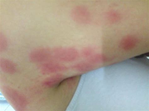 Itchy Rash On Arm Caused By Bed Bug Bites Picture Of Days Inn Edison