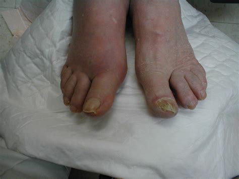 Gout Of The Right Great Toe Diffuse Swelling And Redness Grepmed