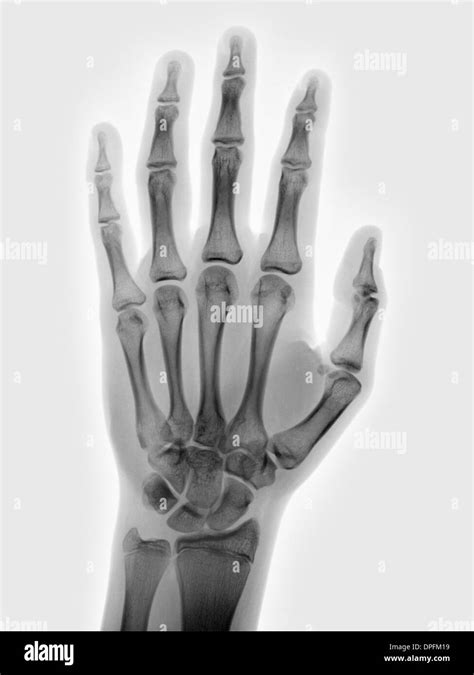 Normal Left Hand X Ray