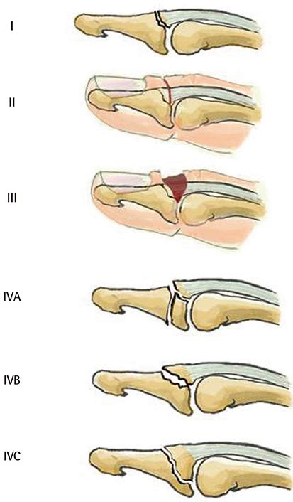 Mallet Finger Hand Orthobullets